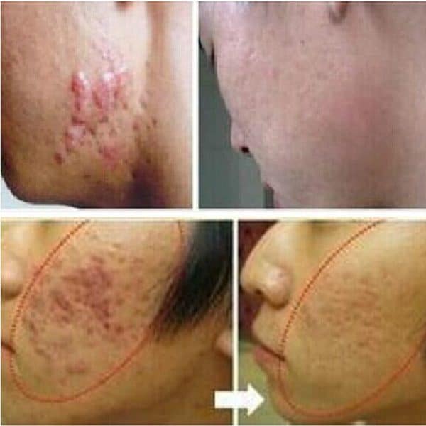 Acne Scar Remover Cream - Image 4