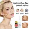 Mole & Skin Tag Removal Solution