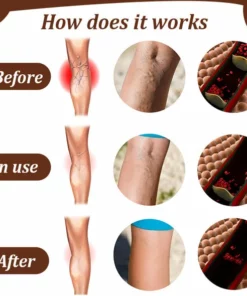 LegVeins OrganicPatch