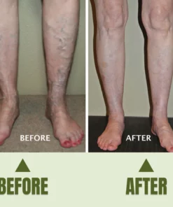 Varicose Veins Healing Cream