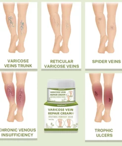 Varicose Veins Healing Cream