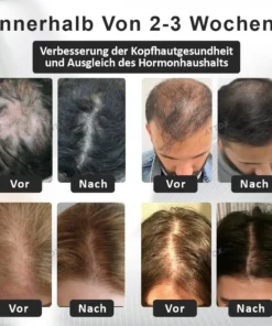 ATTDX™ Alopecia Wiederherstellungs Haar Booster Roll-On