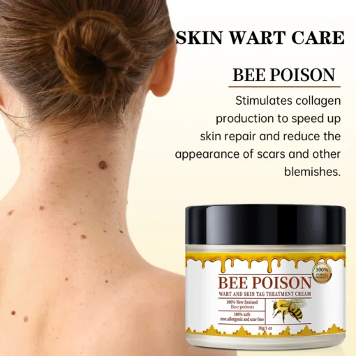 Bee poison Wart and Mole Removal Treatment Cream