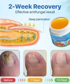 Biancat™ Anti-Fungal Nail Repair Ointment