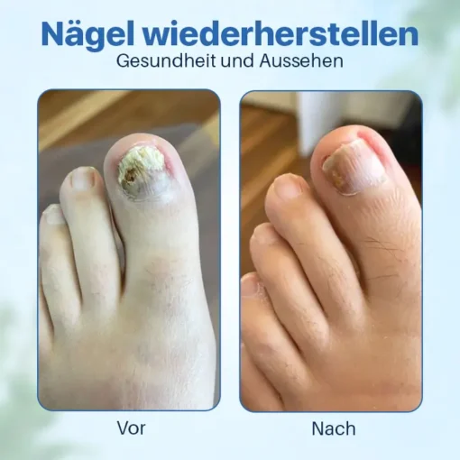 Biancat™ Antifungale Nagelreparatur-Salbe