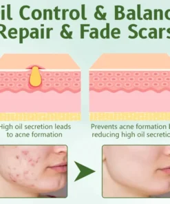 Ceoerty™ LeafNurture Acne Removal Cream