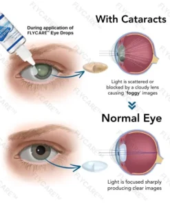 FLYCARE™ Myopia Reversal Eye Drops