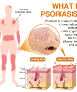 LOVILDS™PsoriaHeal psoriasis Spray