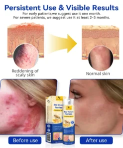 LOVILDS™PsoriaHeal psoriasis Spray