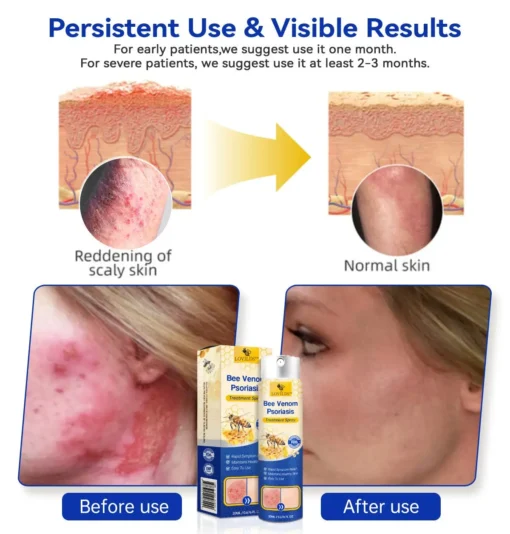 LOVILDS™PsoriaHeal psoriasis Spray