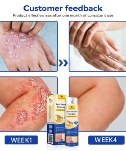 LOVILDS™PsoriaHeal psoriasis Spray