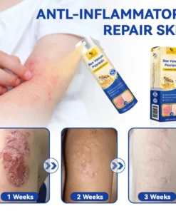 LOVILDS™PsoriaHeal psoriasis Spray