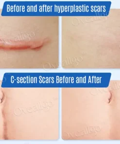 Oveallgo™ Silicone Anti-Scar Cream