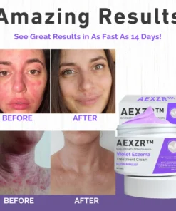 AEXZR™ Violet Eczema Treatment Cream