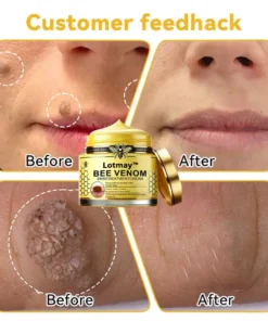 [Winter-Skincare] Lotmay™ Bee Venom Skin Treatment Cream（AAD RECOMMENDED）