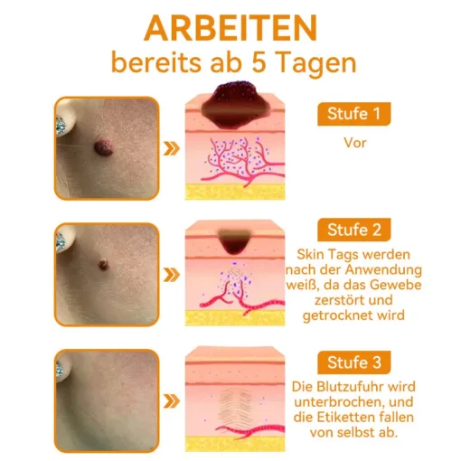 Vsoxa™ Bienengift Waren & Muttermalenfernung Creme - Image 11