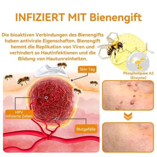 Vsoxa™ Bienengift Waren & Muttermalenfernung Creme - Image 8